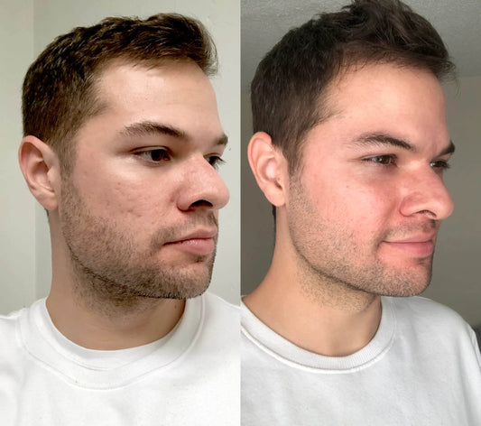 90 Day SKIN DISCIPLINE Review w/ Before &amp; After - Acne Supplement by ZitSticka - Nick DiRamio
