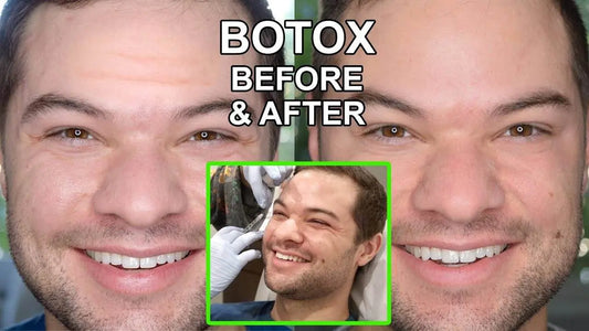 Botox for Wrinkles Before and After - Nick DiRamio