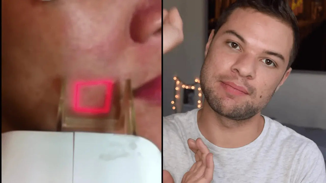 Laser Skin Resurfacing - Getting Fractional C02 Laser Procedure for Acne Scar Removal - Nick DiRamio