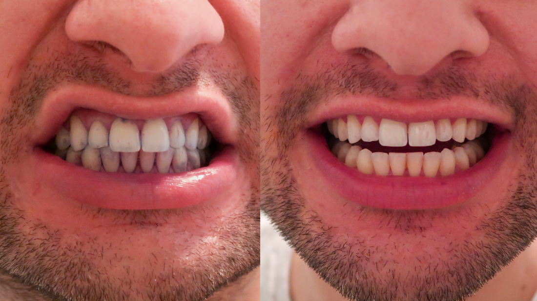 Dental Duty Review Electric Toothbrush Review &amp; Manual Vs Electric Toothbrush Experiment