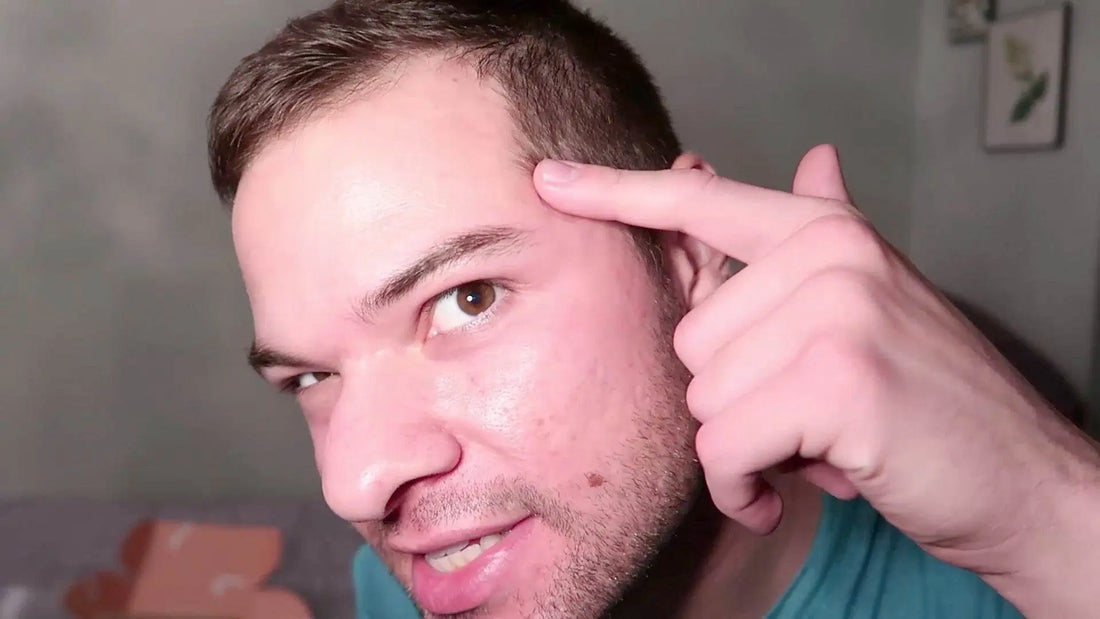 Zitsticka Killa Pimple Patch Review with Before and After Pictures - Nick DiRamio