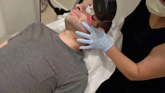 Acne Scar Removal - My Second Round of Fractional Laser Skin Resurfacing - Nick DiRamio