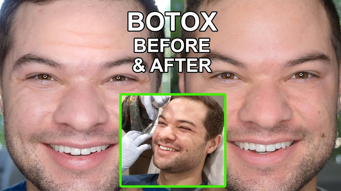 Botox for Wrinkles Before and After